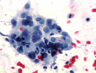Areas epidermoides x 400