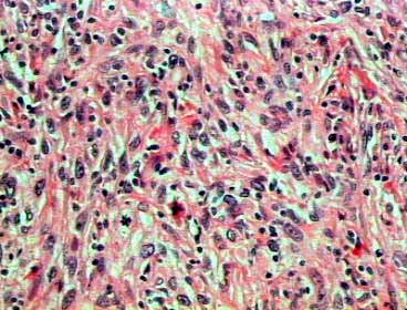 reas semejantes al fibrohistiocitoma maligno x 200