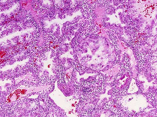 Biopsia de Endometrio - 100x