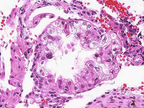 Biopsia de Endometrio - 400x