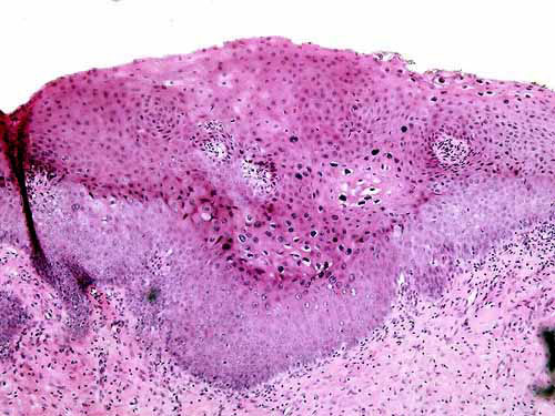 Biopsia de Cuello Uterino a 100x