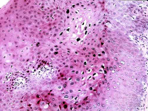 Biopsia de Cuello Uterino a 200x