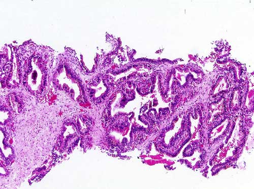 Biopsia de Prstata - 100x