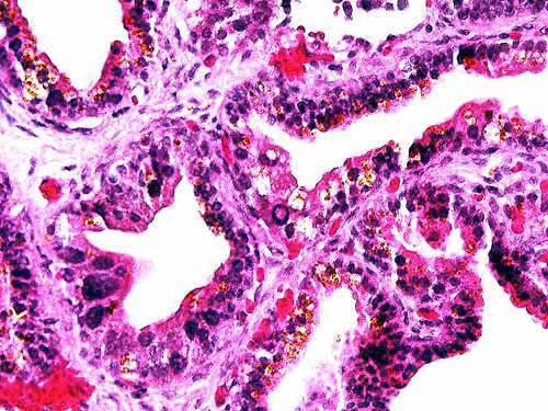 Biopsia de Prstata - 400x