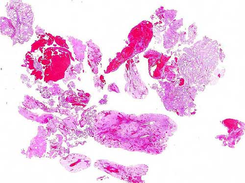 Biopsia de Endometrio - Caso 01