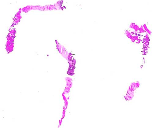 Biopsia de Prstata - Caso 05
