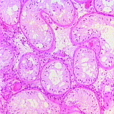 Imagen de MORFOMETRA DEL NCLEO DE LA CLULA DE SERTOLI EN PACIENTES INFRTILES CON SNDROME DE SOLO CLULAS DE SERTOLI