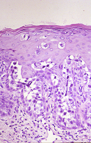 Imagen de CARCINOMA UROTELIAL IN SITU DETECTADO POR DISEMINACIN PAGETOIDE EN PENE