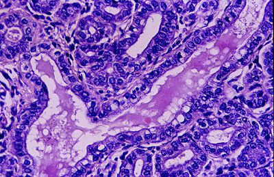 Imagen de DIAGNSTICO INTRAOPERATORIO POR IMPRONTA CITOLGICA DE UN ADENOMA LACTACIONAL. DESCRIPCIN DE UN CASO.