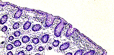 Imagen de UN CASO ESPAOL DE ESPIROQUETOSIS INTESTINAL