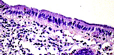 Imagen de UN CASO ESPAOL DE ESPIROQUETOSIS INTESTINAL