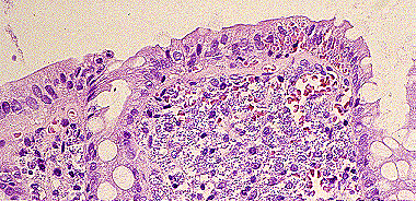 Imagen de LEISHMANIASIS EN BIOPSIA DIGESTIVA