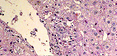Imagen de LEISHMANIASIS EN BIOPSIA DIGESTIVA