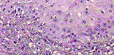 Imagen de LEISHMANIASIS EN BIOPSIA DIGESTIVA