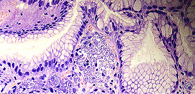 Imagen de LEISHMANIASIS EN BIOPSIA DIGESTIVA