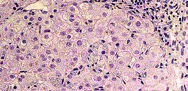 Imagen de LEISHMANIASIS EN BIOPSIA DIGESTIVA