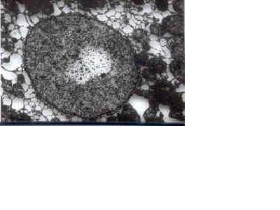 Imagen de ULTRAESTRUCTURA DEL TEJIDO HEPATICO EN PACIENTES CON ENFERMEDAD DE WILSON.