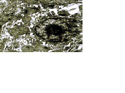 Imagen de ULTRAESTRUCTURA DEL TEJIDO HEPATICO EN PACIENTES CON ENFERMEDAD DE WILSON.