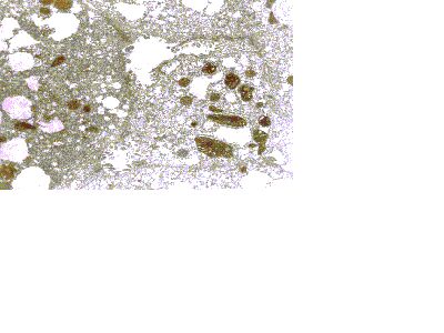 Imagen de ULTRAESTRUCTURA DEL TEJIDO HEPATICO EN PACIENTES CON ENFERMEDAD DE WILSON.
