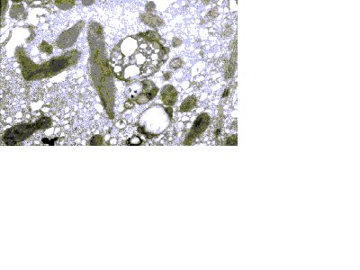 Imagen de ULTRAESTRUCTURA DEL TEJIDO HEPATICO EN PACIENTES CON ENFERMEDAD DE WILSON.