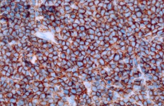 Imagen de PROCESO LINFOPROLIFERATIVO POST TRASPLANTE AUTOLOGO DE MEDULA OSEA: LINFOMA TIPO BURKITT ASOCIADO CON VIRUS DE EPSTEIN  BARR