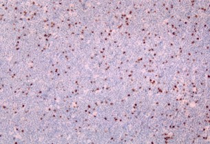 Imagen de PROCESO LINFOPROLIFERATIVO POST TRASPLANTE AUTOLOGO DE MEDULA OSEA: LINFOMA TIPO BURKITT ASOCIADO CON VIRUS DE EPSTEIN  BARR