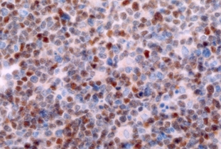 Imagen de PROCESO LINFOPROLIFERATIVO POST TRASPLANTE AUTOLOGO DE MEDULA OSEA: LINFOMA TIPO BURKITT ASOCIADO CON VIRUS DE EPSTEIN  BARR
