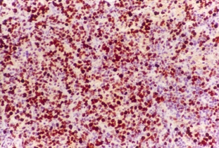 Imagen de PROCESO LINFOPROLIFERATIVO POST TRASPLANTE AUTOLOGO DE MEDULA OSEA: LINFOMA TIPO BURKITT ASOCIADO CON VIRUS DE EPSTEIN  BARR