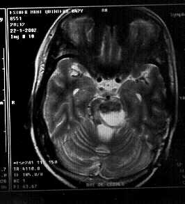 Imagen de Metstasis cerebral de un adenocarcinoma de cuello uterino. A propsito de un caso.