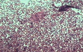 Imagen de Histiocitosis Reactiva de Clulas de Langerhans.Presentacin de un caso