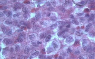 Imagen de Histiocitosis Reactiva de Clulas de Langerhans.Presentacin de un caso