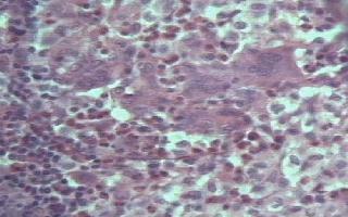 Imagen de Histiocitosis Reactiva de Clulas de Langerhans.Presentacin de un caso