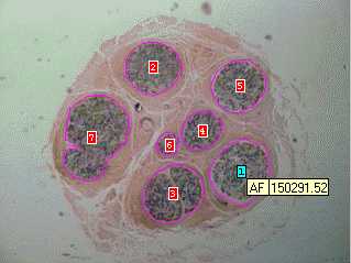 Imagen de MORFOMETRA COMPUTARIZADA  EN BIOPSIAS DE NERVIO SURAL