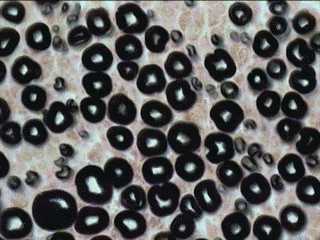 Imagen de MORFOMETRA COMPUTARIZADA  EN BIOPSIAS DE NERVIO SURAL