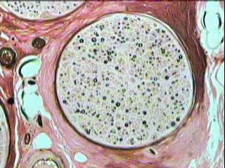 Imagen de MORFOMETRA COMPUTARIZADA  EN BIOPSIAS DE NERVIO SURAL