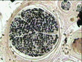 Imagen de MORFOMETRA COMPUTARIZADA  EN BIOPSIAS DE NERVIO SURAL