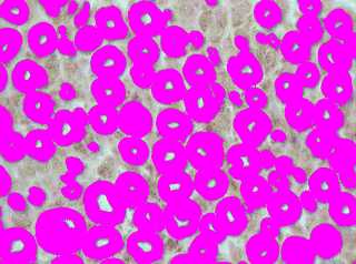 Imagen de MORFOMETRA COMPUTARIZADA  EN BIOPSIAS DE NERVIO SURAL