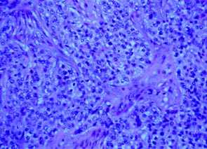 Imagen de HIDRADENOMA NODULAR MALIGNO