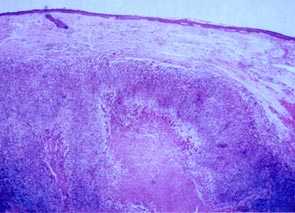 Imagen de HIDRADENOMA NODULAR MALIGNO