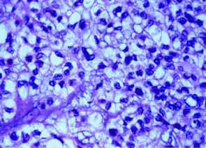 Imagen de HIDRADENOMA NODULAR MALIGNO