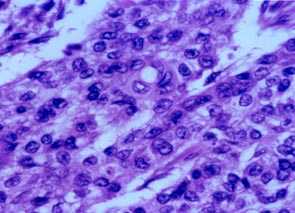 Imagen de HIDRADENOMA NODULAR MALIGNO