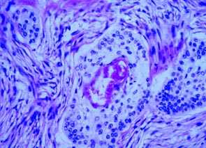 Imagen de HIDRADENOMA NODULAR MALIGNO