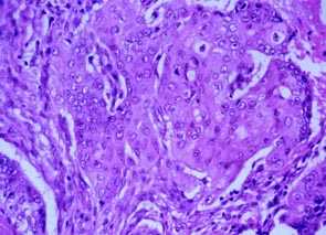Imagen de HIDRADENOMA NODULAR MALIGNO