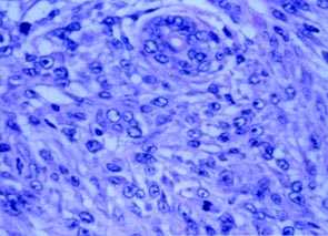Imagen de HIDRADENOMA NODULAR MALIGNO