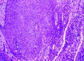 Imagen de HIDRADENOMA NODULAR MALIGNO