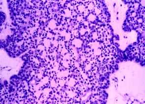 Imagen de HIDRADENOMA NODULAR MALIGNO