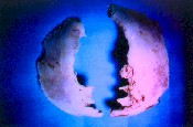 Espculas seas en rea diasttica